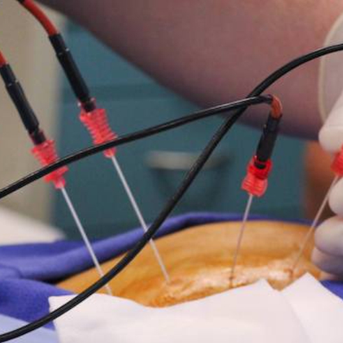 Pioneirismo em Radiofrequência